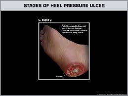 New Jersey Nursing Home Attorney | Bedsores & Ulcer Injury | Cherry Hill