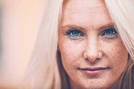 Hyperpigmentation Treatment in Clyde Hill