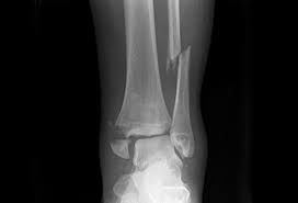 Both the end of the fibula (1) and the tibia (2) are broken and the malleolar fragments (arrow: Ankle Fractures Trauma Orthobullets
