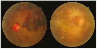 Coronavirus updates due to the coronavirus pandemic, eye screening services across the uk were paused for most people. Retinal Images Benchmark For The Detection Of Diabetic Retinopathy And Clinically Significant Macular Edema Csme