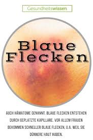 Bluterguss — ↑ekchymose, ↑hämatom, ↑suffusion, ↑sugillation … das große fremdwörterbuch. Blaue Flecken Hat Jeder Mal Irgendwo Gestossen Hingefallen Oder Bei Einem Umzug Geholfen Ein Solcher Bluterguss Ist Nicht Sc Flecken Korper Und Seele Medizin