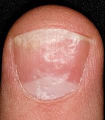 Maybe you would like to learn more about one of these? Thick Toenails Diagnosis Treatment Foot Pain Explored