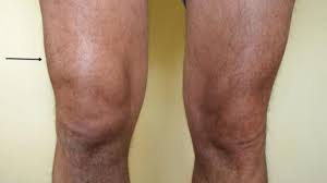 Salah satu penyebab lutut bengkak adalah cedera yang menyebabkan terkilir atau keseleo. Cara Praktis Hilangkan Bengkak Akibat Asam Urat Tinggi