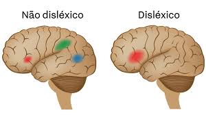 A dislexia pode ser adquirida — quando surge na sequência de traumatismo ou lesão cerebral, ou de desenvolvimento — perturbação ou atraso diante dessa lista de sintomas e graves consequências geradas, cabe salientar que, de acordo com bonini et al (2010), a dislexia não é resultado de. Curso De Ingles Para Dislexicos Tudo O Que Voce Precisa Saber Spindow
