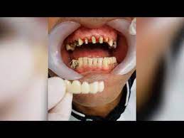 تلبيس الاسنان الاماميه بالصور عملية تلبيس الأسنان