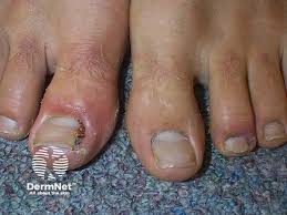 Image result for Paronychia feet