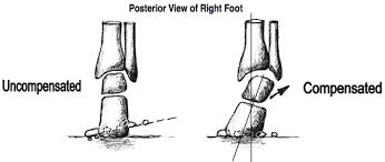 Image result for Rearfoot Varus (right foot)