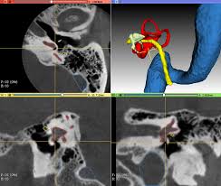 Image result for Temporal Bone