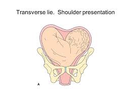 Image result for Shoulder Presentation