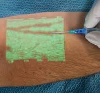 Near-infrared light tech supports vein access procedures