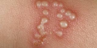 Herpetic whitlow causes blister and pain that is intense. Genital Herpes Treatment At Home Hsv 2 Online Treatment Herp Alert