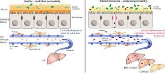 Download this premium vector about diagram showing cirrhosis of the liver, and discover more than 12 million professional graphic resources on freepik. The Gut Liver Axis In Liver Disease Pathophysiological Basis For Therapy Journal Of Hepatology