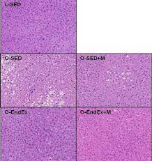 Treatment Of Nonalcoholic Fatty Liver Disease With Metformin Exercise Download Scientific Diagram