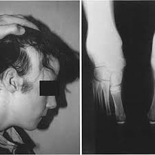 The propositus showing alopecia areata and the absence of the fifth toe... 