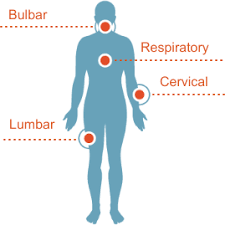 Amyotrophic lateral sclerosis (als) is the most common degenerative disease of the motor neuron system. Als Pathophysiology Als Causes Als Pathways