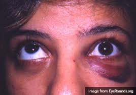 Image result for Diplopia