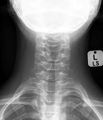 Image result for Croup