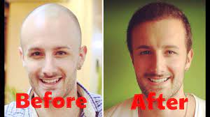 In men, hair loss at the temples and a balding crown are the most common forms of baldness. How Much Does A Hair Transplant Cost Answered Youtube