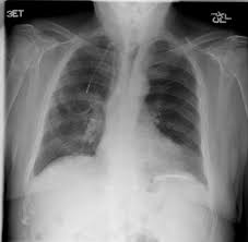 Not always, in the region of a plaque); Calcified Pleural Plaques Radiology Case Radiopaedia Org