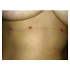 Image result for Trombicula autumnalis bites