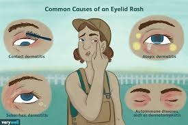 mon causes of eyelid rashes