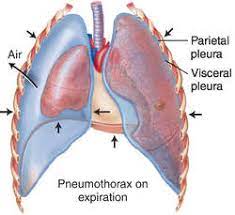 This air pushes on the outside of your lung and makes it collapse. Closed Pneumothorax Definition Of Closed Pneumothorax By Medical Dictionary