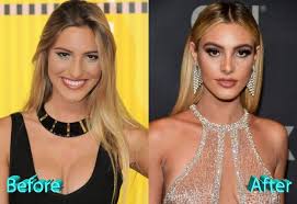 Lele Pons Before And After Nose Job Rhinoplasty Nose Jobs Nose Plastic Surgery Big Nose Beauty