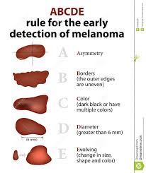 Can melanoma skin cancer be found early? The 5 Signs Of Melanoma Bridgeway Senior Living