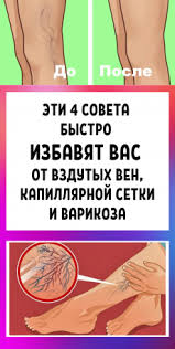 как избавиться от целлюлита при варикозе в домашних условиях Samoe Interesnoe Dobavila V Zakladki Kak Stat Luchshe Postila V 2020 G Varikoz Zhurnal O Zdorove Holisticheskaya Medicina