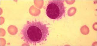 Radiation Therapy For Multiple Myeloma Myeloma Center