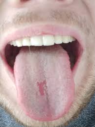 Rinse the scraper after each stroke and don't press too hard. Wtf Is This I Often Clean My Tongue But Sometimes It Comes Back Dermatology