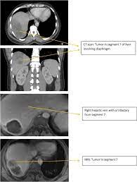 Omental mesothelioma is extremely rare, but it is possible and is probably associated with asbestos exposure. Primary Intrahepatic Mesotheliomas A Case Presentation And Literature Review Sciencedirect