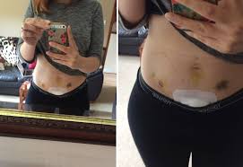 My Endometriosis Story Stage 4 Laparoscopy Operation Endometriosis Endometriosis Surgery Laparoscopy Endometriosis