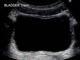 Normal Bladder Ultrasound How To