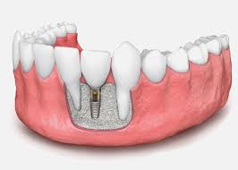 What is a Dental Implant Bone Graft? - Britely