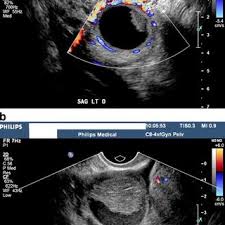So it makes sense that we would all want to know how to get screened for this condition so that we could discover it and treat it as early as possible. Pdf Transvaginal Ultrasound Assessment Of The Premenopausal Ovarian Mass