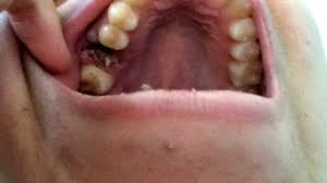 Bleeding after wisdom teeth removal is quite normal, for 1, 2, 3, even 4 days. What To Eat Not To Eat After Wisdom Tooth Extraction Dr Ismail Health Care Group