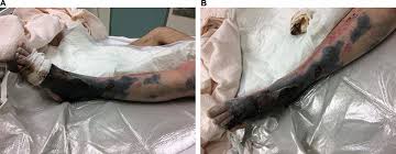 Invasive, toxigenic infections can result in necrotizing fasciitis, myositis and streptococcal toxic shock syndrome. A Case Of Fulminant Necrotising Fasciitis Bmj Case Reports