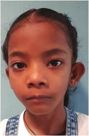 Short Stature Syndromes: Case Series from India