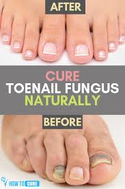 How To Get Rid Of Thick Toenails With Top 5 Home Remedies Thick Toenails Toe Nails Nail Remedies