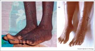 2 days ago · monkeypox is an infectious disease caused by the monkeypox virus that can occur in certain animals including humans. A Legs And Feet Of Monkeypox Patient Photo Courtesy Of J Harvey Download Scientific Diagram