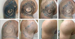 Read about costs, number of sessions required and recovery. Sugar Land Laser Tattoo Removal Prices Laser Tattoo Removal Houston