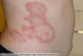 The circular shape of the lesion is often mistaken for ringworm. Lyme Disease Rash Vs Other Rashes