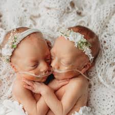 Fundraiser by Dana Young : Hickey Conjoined Twins