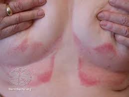Image result for Intertrigo under breasts