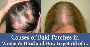 Causes Of Bald Patches In Women S Head And How To Get Rid Of It