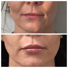 We did not find results for: Interface Group On Twitter Who Doesn T Love A Great Before And After Picture These Beautiful Lips Are The Result Of 1 Syringe Of Volbella And 1 Syringe Of Juvederm Ultra You Only