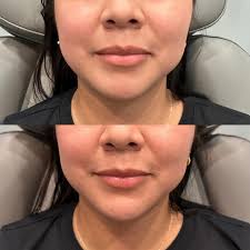 ✨ PRP for Under-Eye Rejuvenation ✨ Say goodbye to tired eyes! 👋 PRP  (Platelet-Rich Plasma) therapy uses your body's own healing power to  improve dark circles, fine lines, and under-eye hollows—naturally🩸💉🧬 🔬