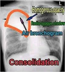 Image result for Air Bronchogram