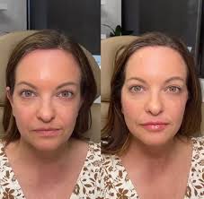 PDO Thread Lift + Lip refresh 🤍 Angela Williams BSN, RN PrimeMD Aesthetics  + Wellness Raleigh, NC 919-948-6355 #threadlift #facelift #pdothreads  #lipfiller #balance #facialbalancing #fullfacerejuvenation #beforeandafter  #collagen #skincare